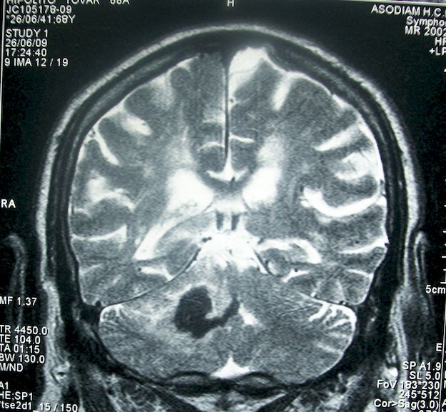 MRI felvétel stroke után