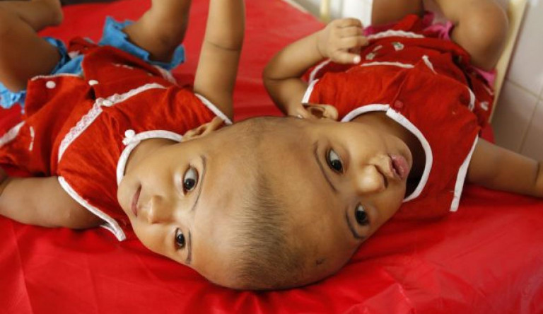 Magyar orvosok választottak szét a fejüknél összenőtt sziámi ikreket