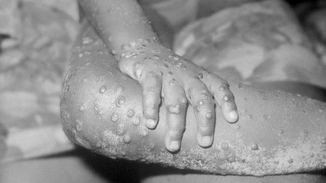 WHO: a majomhimlő új elnevezése mpox